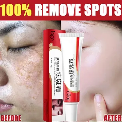 Creme clareador para manchas, universal para pele